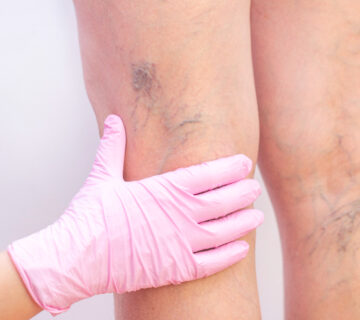 leczenie żylaków kończyn dolnych